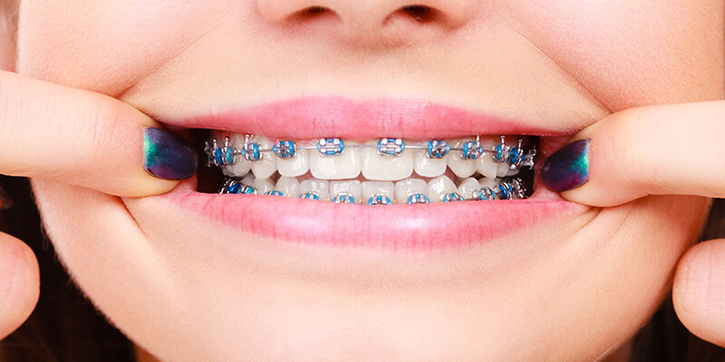 Diş teli tedavisi ne kadar sürer?
