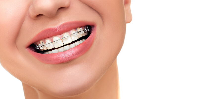 Ortodontik Aparey Nedir?