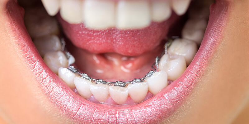 Ortodontik tedavi amacıyla diş çekimi
