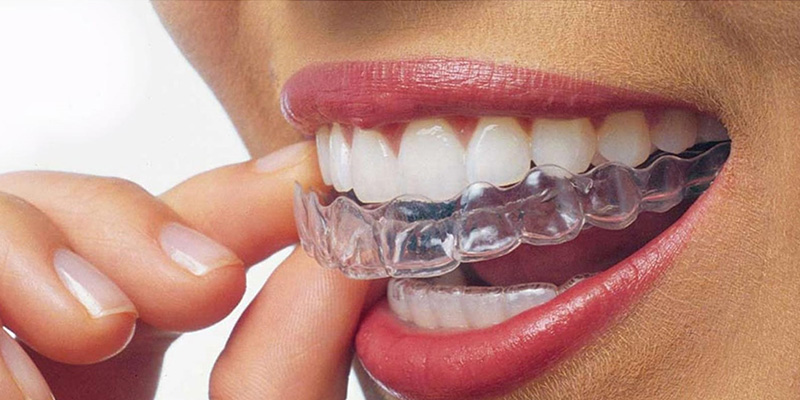 Tedavi sonrası dişler eski durumuna doğru kayabilir mi?